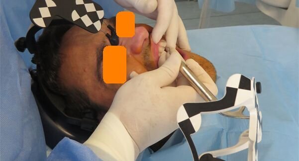 Figg. 6a-6d - Tracciatura della superficie di riferimento in tempo reale. a) Calibrazione del tastatore; b) Selezione dei denti e dei punti di partenza della scansione per tastatura; c) Fasi di scansione (tracer registration); d) Dettaglio clinico della procedura di tracer registration.