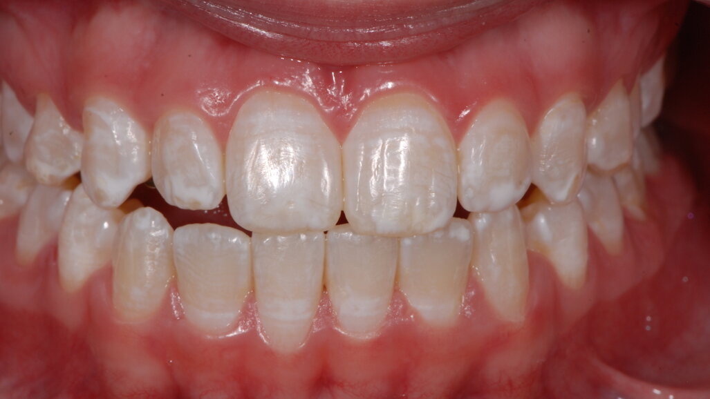 Los efectos adversos del aclaramiento dental