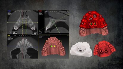 Orthodontic appliances on temporary anchorage devices: Single-stage procedure