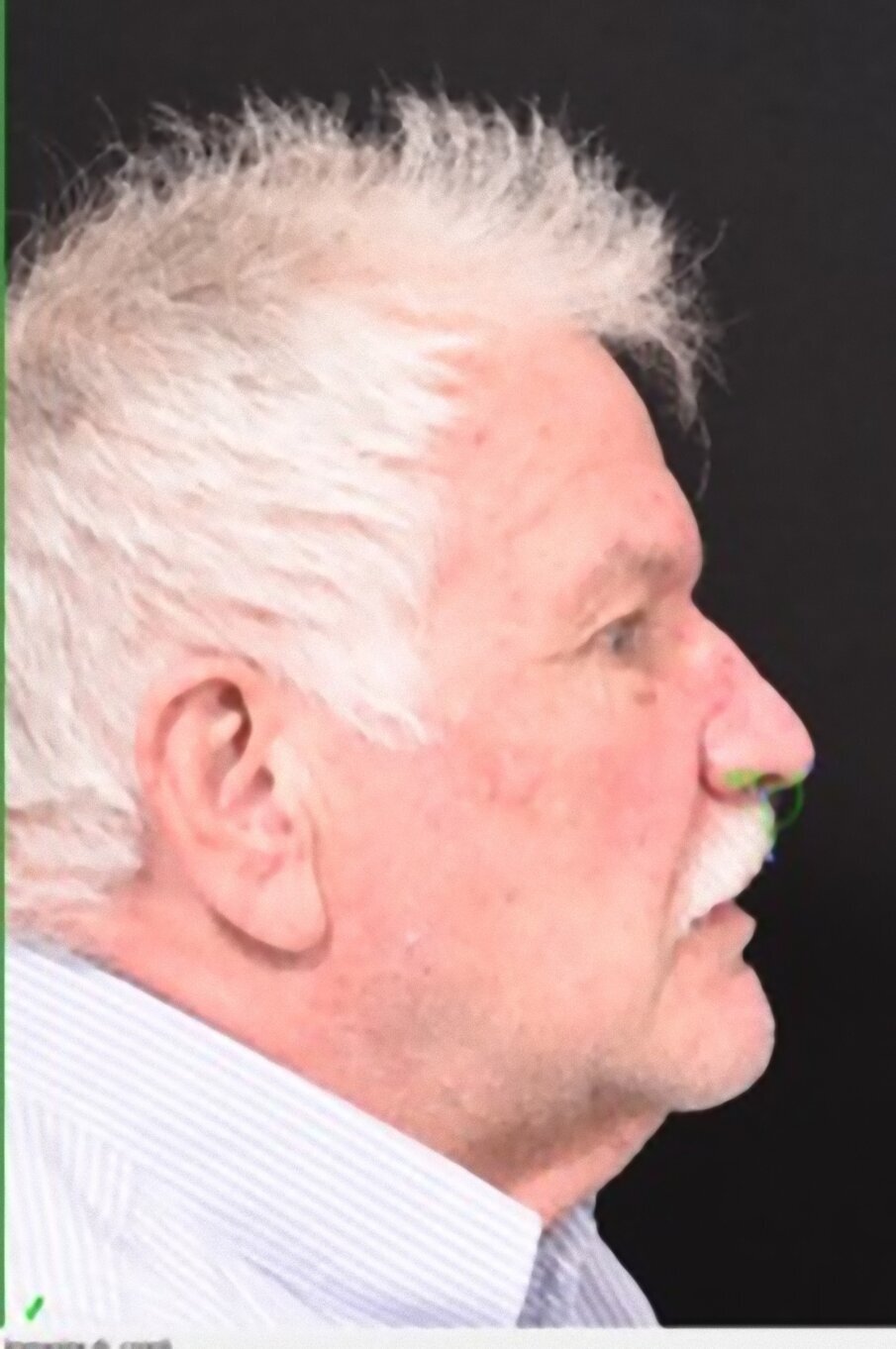 Fig. 5_Angolo naso-labiale.