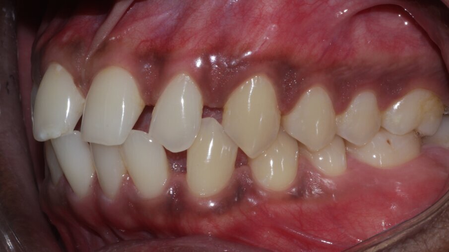 Fig 3: Pre op in occlusion
