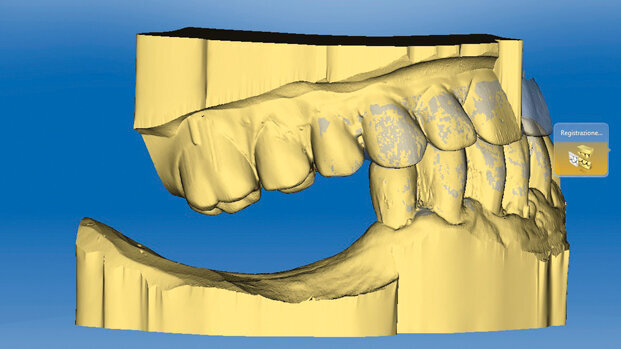 Efficienza del flusso digitale nelle riabilitazioni implantoprotesiche: Virtual Rehabilitation Concept (VRC)