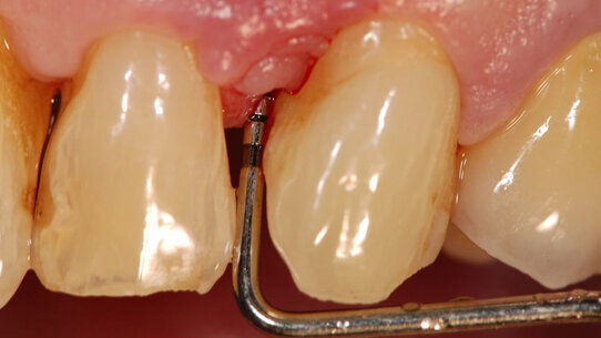 Rigenerazione parodontale  in zona estetica