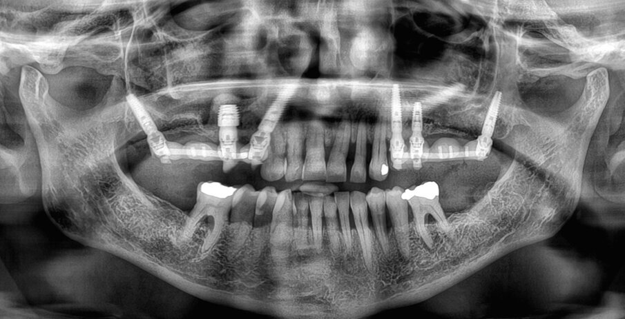Obr. 5: Pooperační rentgenový snímek.