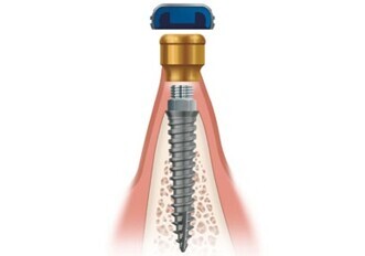 ZEST Anchors introduces a new narrow-diameter implant system featuring overdenture attachment