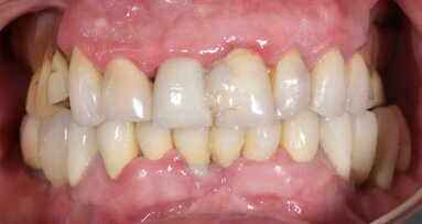 Нов дигитален протокол за възстановяване на цяла зъбна дъга