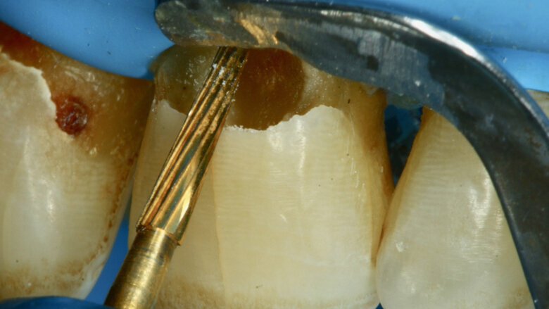 Figura 7. Se utiliza una fresa multilaminada para mejorar el mimetismo y la adhesión al esmalte. 