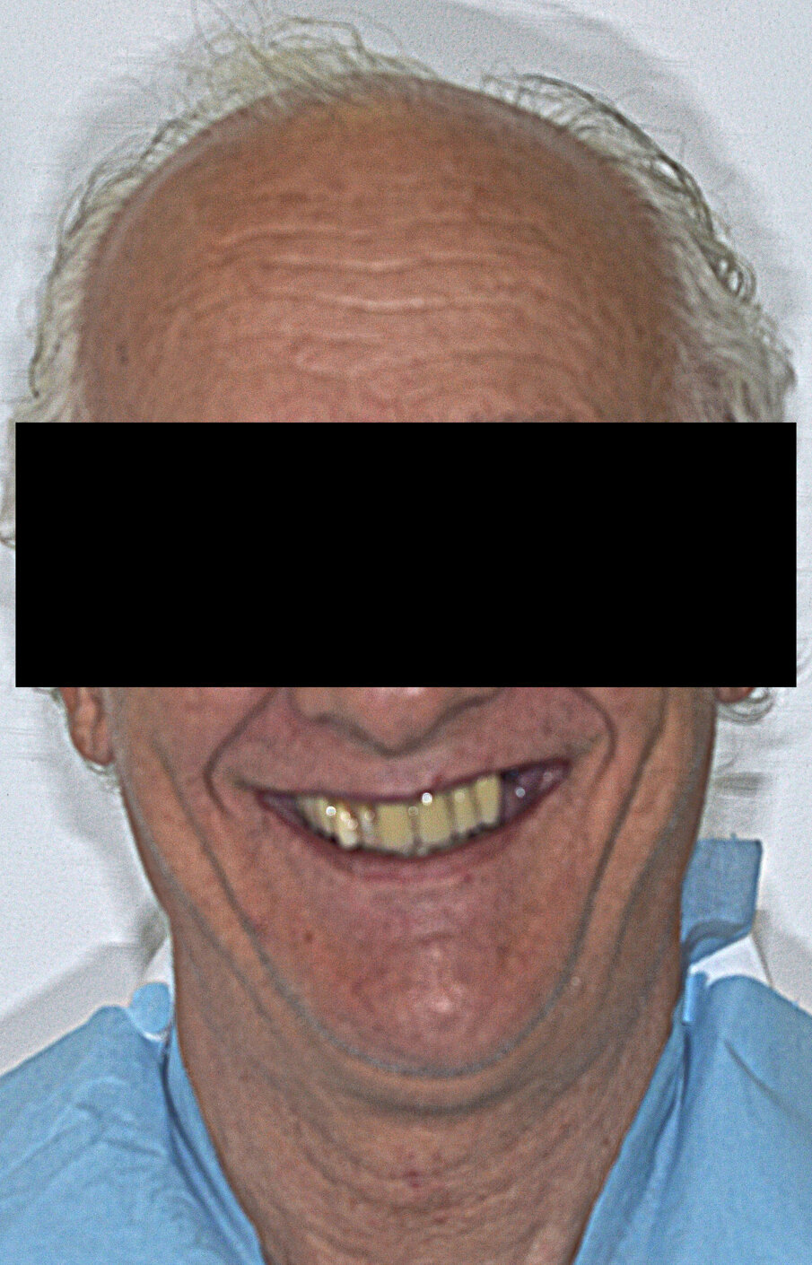 Figg. 10a, 10b_Il sorriso del paziente prima e dopo la fine della terapia.