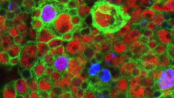 Stammzellen beeinflussen Tumorwachstum im Hirn