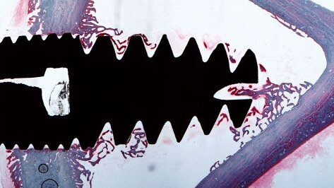 Учени подобряват успеваемостта на зъбните имплантати