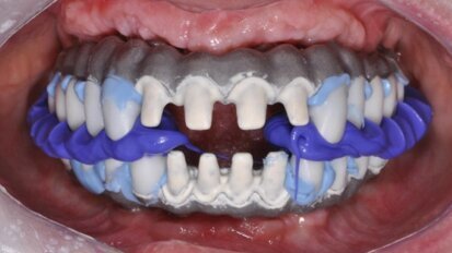 Algorytmy postępowania dla wykonywania indywidualnych rozwiązań protetycznych – cz. II: Suprastruktury przykręcane