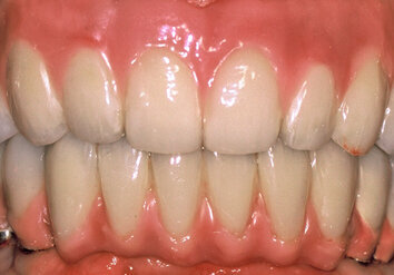 Fig. 12. Final RIRD using telescopic crowns as attachment (front view).