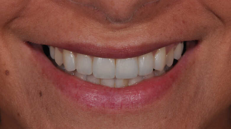 Questions de forme : modifications conservatrices des contours et contacts dentaires