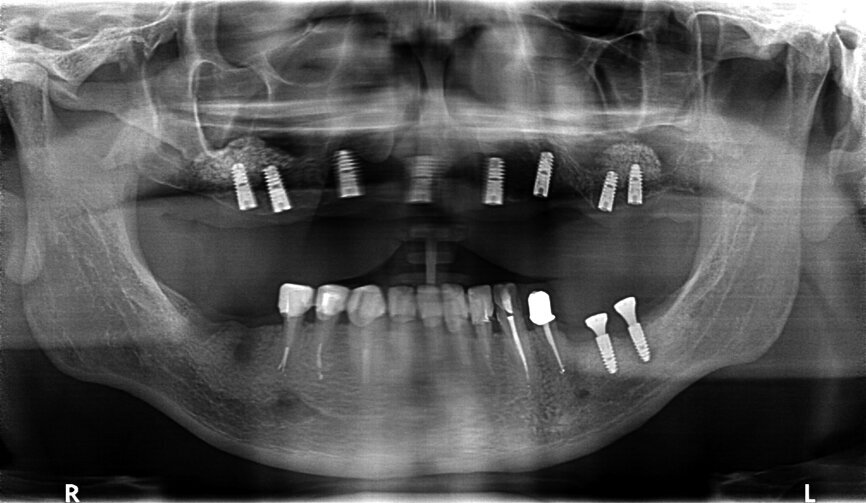 Fig. 30: OPG after placing implants.