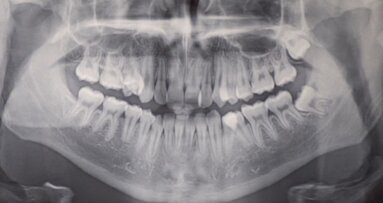 Gestione della terapia estrattiva: case report