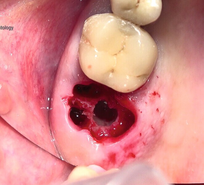 Fig. 50 : Technique d’ostéodensification par compaction du septum inter-radiculaire au moyen de fraises Densah.