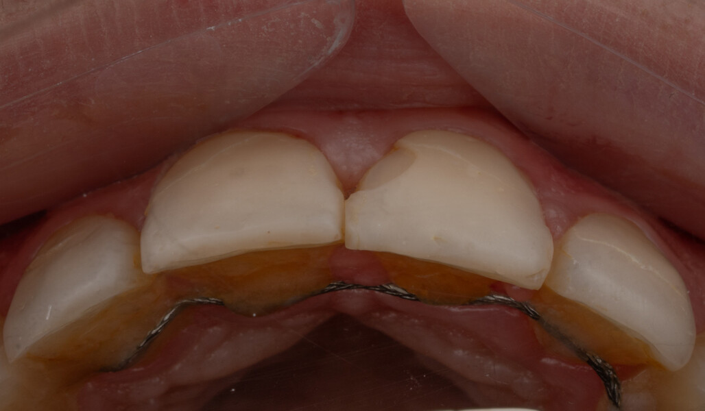 Fig. 1b: Intra-oral occlusal view showing visible defects in the veneers.