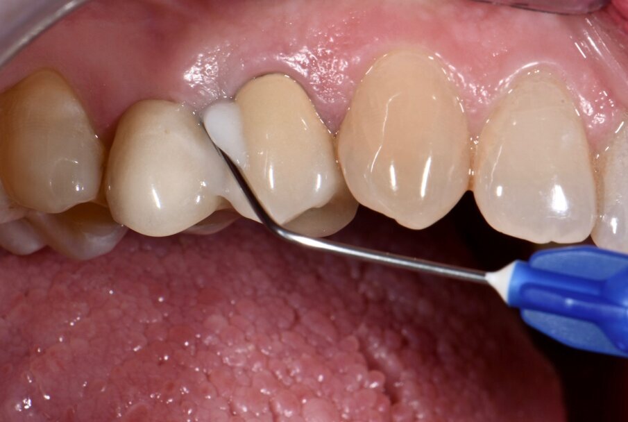 Fig. 4 - Applicazione di gel a base di Xantano e Clorexidina (Chlosite) su impianto #15.