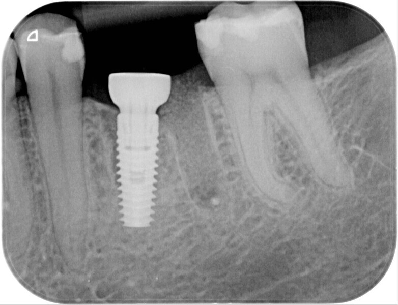 Fig. 8: Post-op radiographic evaluation.