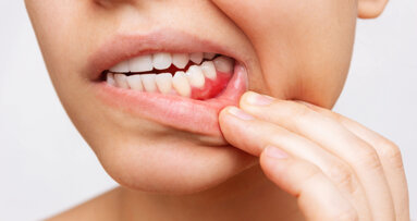 Salivary biomarkers reveal link between periodontitis and metabolic syndrome risk