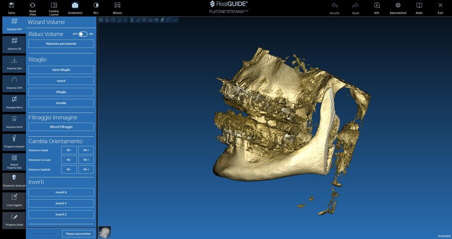 Fig. 2_Artefatti da metallo in corrispondenza della superficie vestibolare delle arcate.
