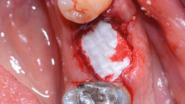 Ricostruzione della cresta in zona 3.6