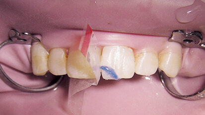 Léčba traumat zubů – doporučené postupy