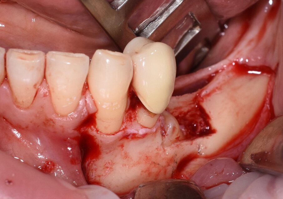 Fig. 7 - Rimozione del tassello osseo e visione della corona del 3.5.