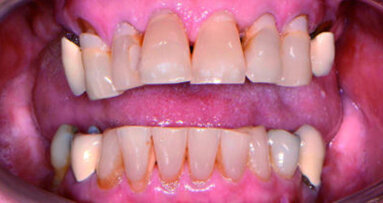 Using CAD/CAM for a combination approach to full mouth reconstruction