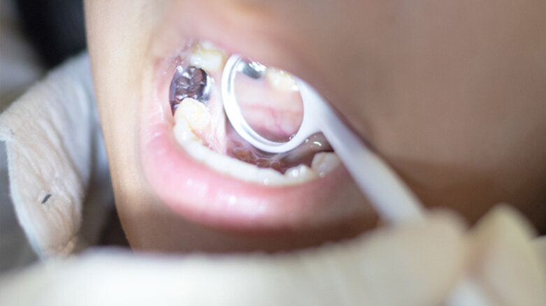 Stufenweise Reduzierung von Amalgam läuft schleppend