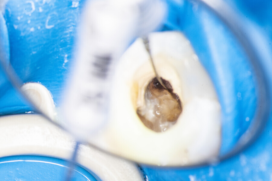 Fig. 18: Scouting the orifice of the MB2 canal in the first molar. There was no possibility of establishing apical patency.