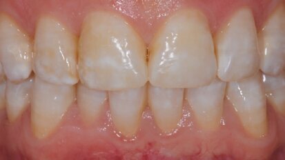 Remineralizacija: preventivni in terapevtski pristop pri nadzoru trdih tkiv