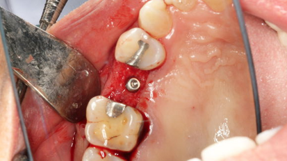 Синтетична мембрана може да ускори оздравяването при имплантиране