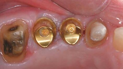 Leczenie odcinka bocznego szczęki z zastosowaniem Encode® Complete Restorative System