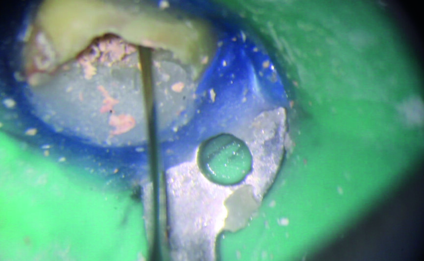 Fig. 4 : Création d’une plate-forme de travail avec une fraise Gates–Glidden modifiée de taille 3. 