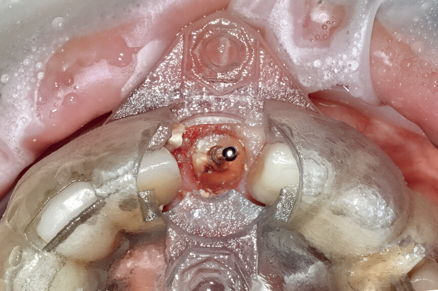 Fig. 17b: Utilising the tooth-borne template and the first insert, initial long shaper drills were used to reach the apex of the root.