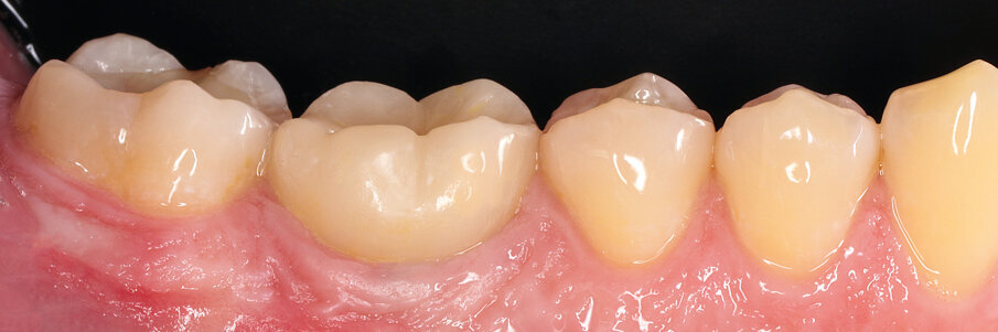 Fig. 34: Check-up after five years: the result is proof of the success of this therapy concept.