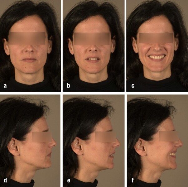 Figs. 53a–f: Post-treatment extra-oral photographs.