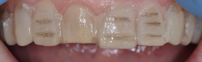 Fig. 17: Mock-up
used as reductions guide for tooth preparation.