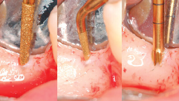 Una nuova tecnica per la preparazione del sito implantare con l’impiego della chirurgia piezoelettrica (PES)