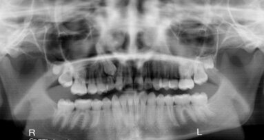 Fyzikální cévní terapie ve stomatochirurgické ordinaci