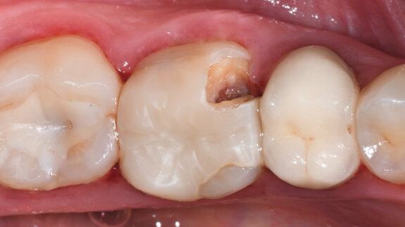 A single-visit digital workflow for endodontic treatment and restoration