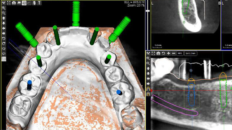 Počítačem asistované, šablonou se řídící okamžité zavedení a zatížení implantátu v dolní čelisti
