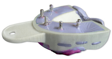 MiraTray Implant Advanced