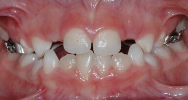 Problemi trasversali: espansione rapida oppure lenta del mascellare?