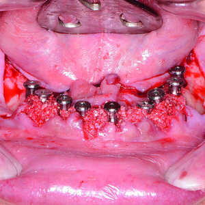 Fig-15-Implants-et-coiffes-de-cicatrisation-entourés-du-matériel-de-greffe-300x300-