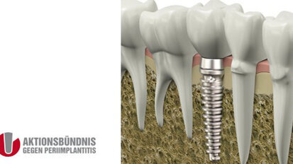 Aktionsbündnis gegen Periimplantitis