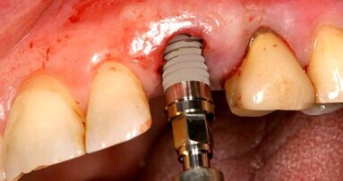Операциите без ламбо и защо все още не трябва да се смятат за рутинен протокол