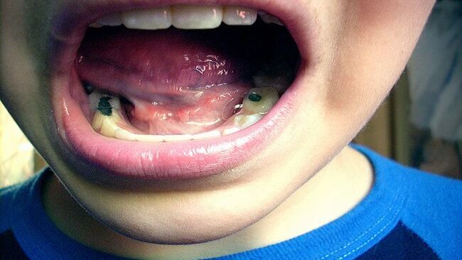 Kaakchirurgen trekken aan de bel over melkgebitten