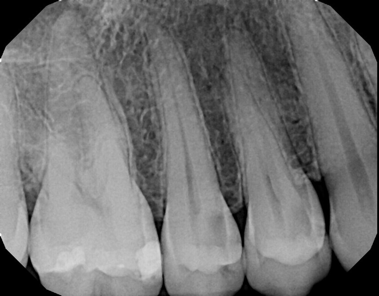 Fig. 18: Initial periapical radiograph demonstrating caries on the mesio-occlusal aspect of teeth #15 and 14 and an absence of periapical pathology.